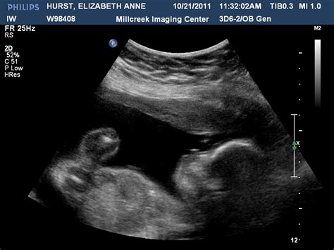 The Hurst Family: Some Ultrasound Pics of our Baby Boy