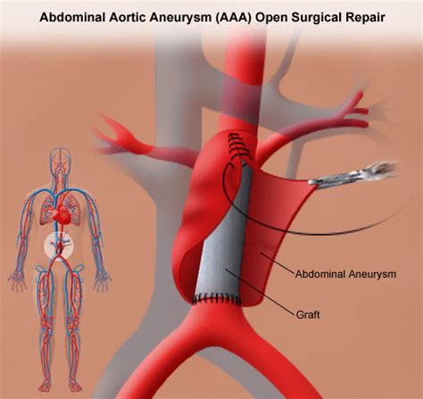 Abdominal Aortic Aneurysm Open Repair | Stanford Health Care