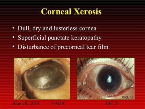 Xerophthalmia