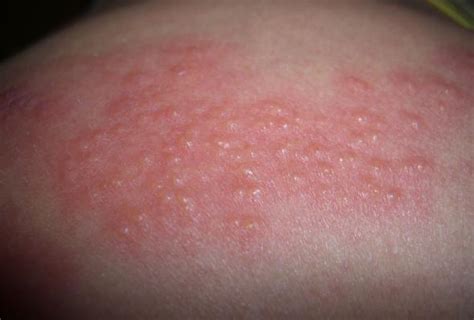 mild shingles rash pictures - pictures, photos