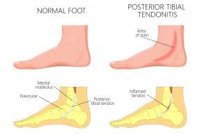 Posterior Tibial Tendonitis - Caruso Foot & Ankle