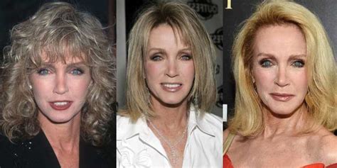 Donna Mills Plastic Surgery Before and After Pictures 2024