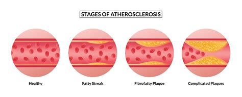 stages of atherosclerosis. Atherosclerosis formation Healthy artery and ...