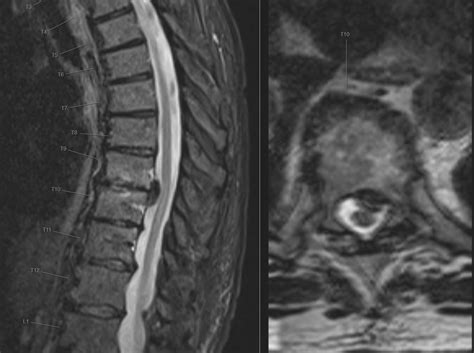 Herniated Disc Thoracic Mri