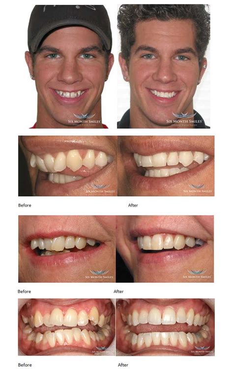 Six Month Smiles & Cosmetic Braces System provided by London Dentist