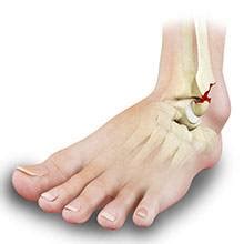 Ankle Fracture Chicago, IL | Ankle Sprain | Ankle Injuries Oak Park, IL