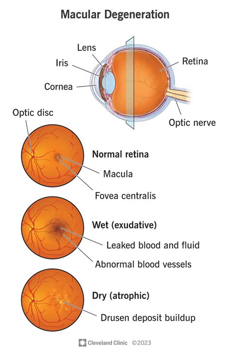 Macular Degeneration: Symptoms, Diagnosis & Treatment