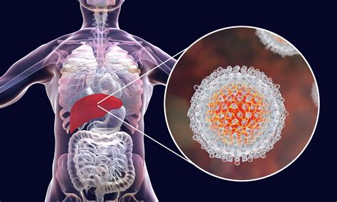 Hepatitis C- How does it occur and ways to manage it? - Yashoda Hospital