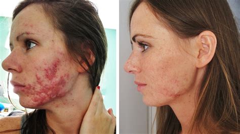 Accutane for Acne Treatment - Zel Skin & Laser Specialists - now ...