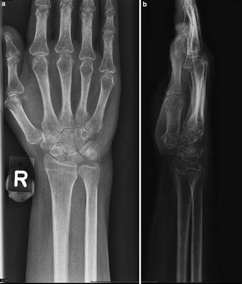 in Osteoporosis | Radiology Key