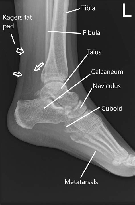 Achilles Tendon Injuries | Complete Orthopedics | Multiple NY Locations