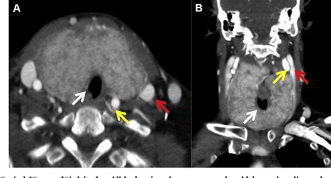 Figure 1 from Riedel's thyroiditis | Semantic Scholar