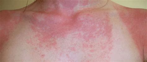 Sun Allergy Rash, Types, Hives, Causes, Symptoms, Pictures, Prevention ...