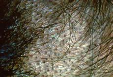 Tinea Capitis Dallas | Fungal Infection of the Scalp Plano, TX