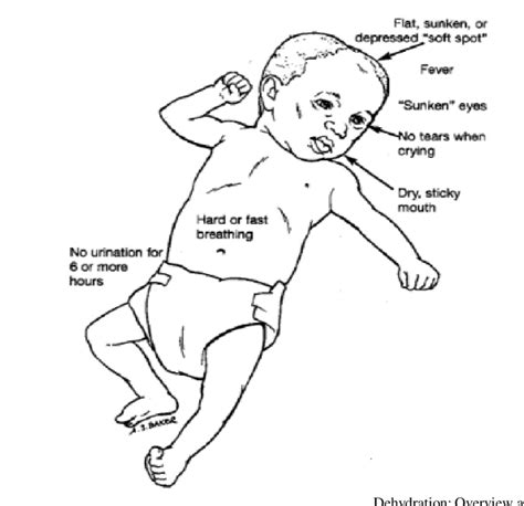 Signs of dehydration. Adapted and reprinted from Nationwide Children's ...