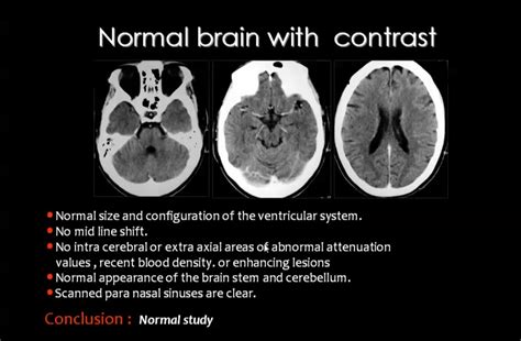 case study : Normal CT brain with contrast :: How to report