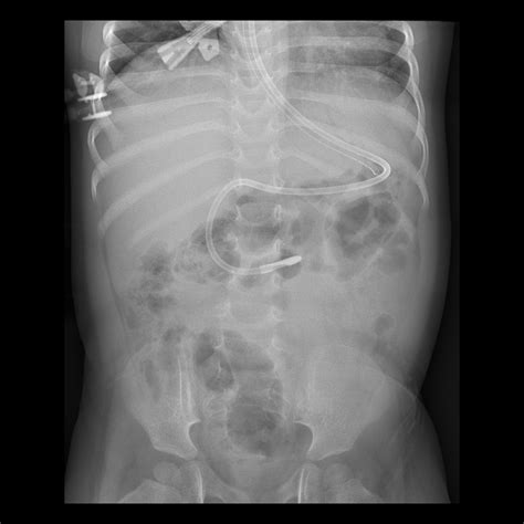 Toddler after feeding tube placement | Pediatric Radiology Case ...