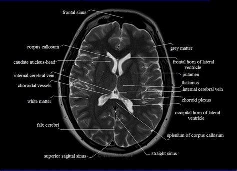 Brain Lobe Anatomy Mri