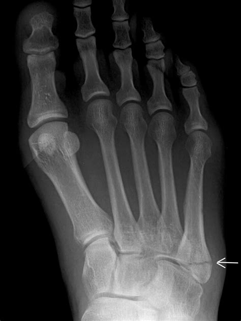 Hairline Fracture Foot - Fracture Treatment