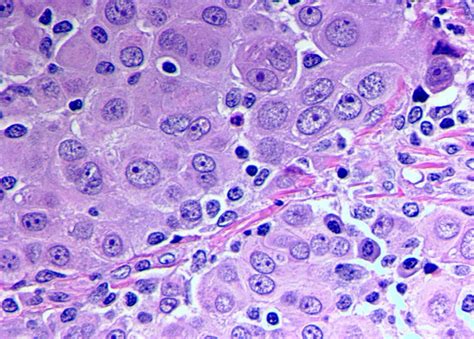 mesothelioma with epithelioid cells Pathology outlines