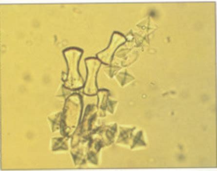 Calcium oxalate dihydrate and monohydrate | Medical Laboratories