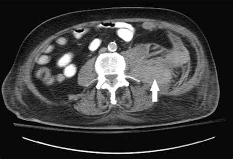 Cureus | Spontaneous Retroperitoneal Hematoma in the Setting of ...