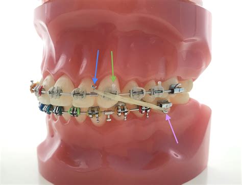 Class II Elastics | About Braces