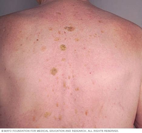 Seborrheic keratosis - Symptoms and causes - Mayo Clinic