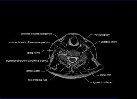 MRI spine anatomy | free MRI axial cervical spine anatomy | Mri ...