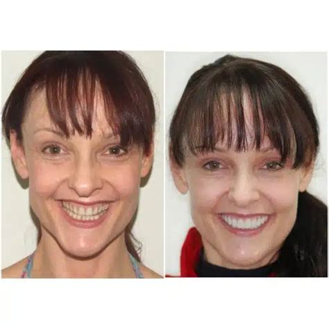 Veneers Before and After Results