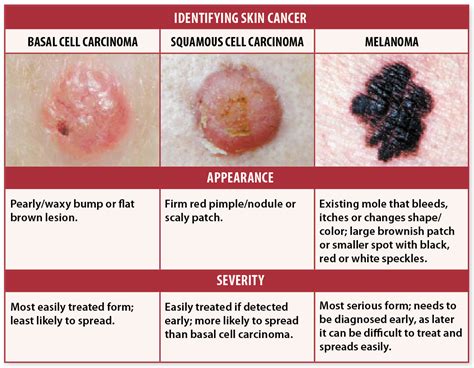 Skin Cancer Signs And Symptoms