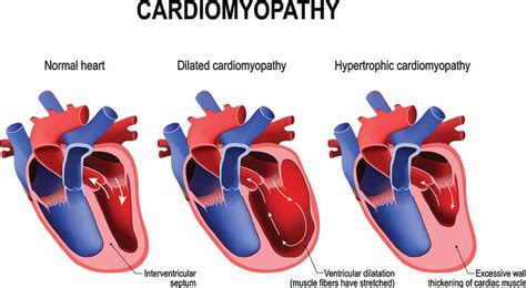 Dilated Cardiomyopathy, Hypertrophic Cardiomyopathy, Heart Failure ...