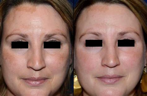 Find Melasma Treatment that Actually Works | Laser Aesthetic Center