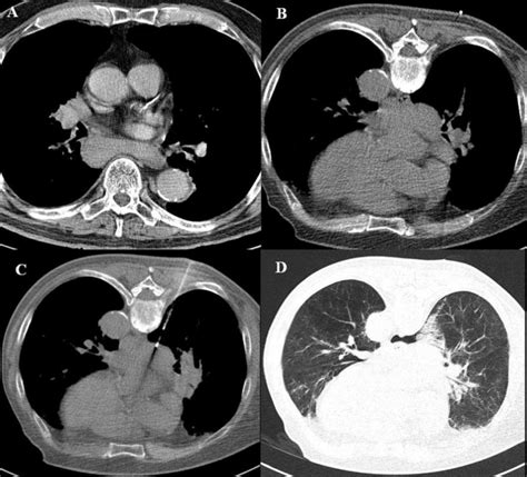 The biopsy of mass in posterior part of the mediastinum. Vascularized ...