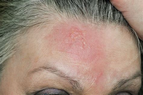 Shingles rash on the forehead - Stock Image - C010/3292 - Science Photo ...