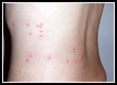 Flea Bites on Humans: Symptoms and Treatment | Dengarden