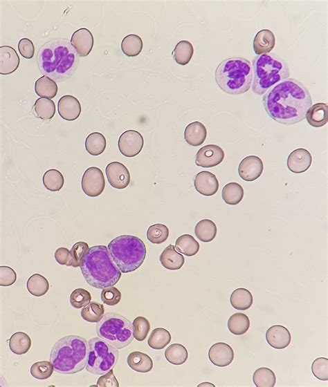 Blood smear at diagnosis. Hematoxylin and eosin–stained blood smear at ...