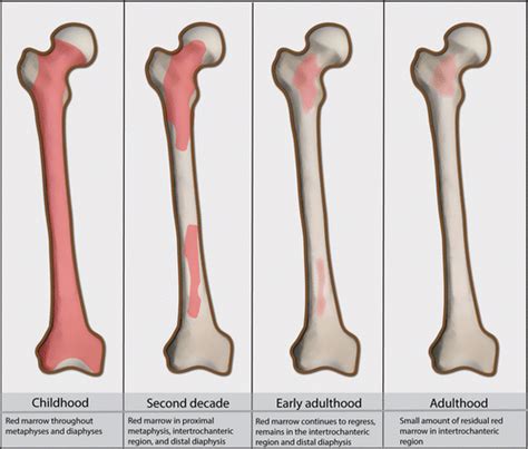 Bone Marrow Edema at Dual-Energy CT: A Game Changer in the Emergency ...