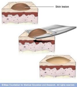 Solving the Puzzle – Excisional vs Shave Biopsy – Miller Family Dermatology