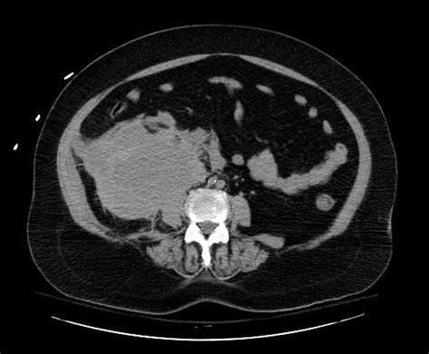 Retroperitoneal hematoma - wikidoc