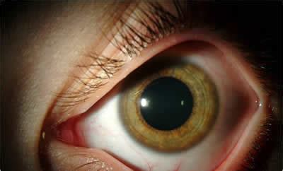 Phlyctenular Keratoconjunctivitis. EyeRounds.org - Ophthalmology - The ...