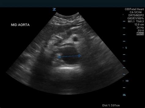 Bilateral Common Iliac Artery Aneurysm - JETem