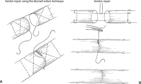 Tendon Repair | Basicmedical Key