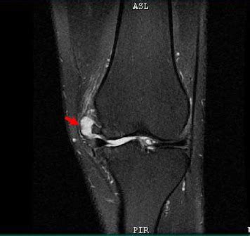 A coronal slice T2-weighted MR image shows a meniscal cyst (red arrow ...