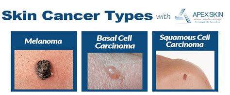 Common Types Of Skin Cancer