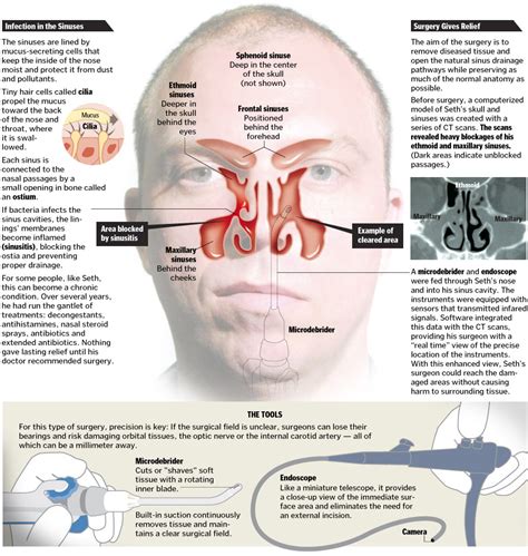 A Better Tomorrow: Image guided sinus surgery