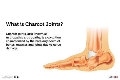 Charcot Joints: Causes, Symptoms, Treatment and Cost