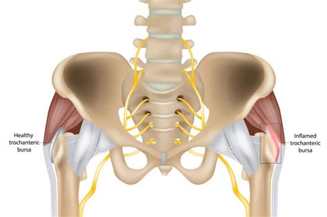 Trochanteric Bursitis Treatment Birmingham - Same Day Treatment