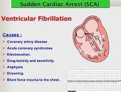 Ventricular Fibrillation