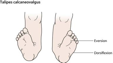 Musculoskeletal disorders | Clinical Gate